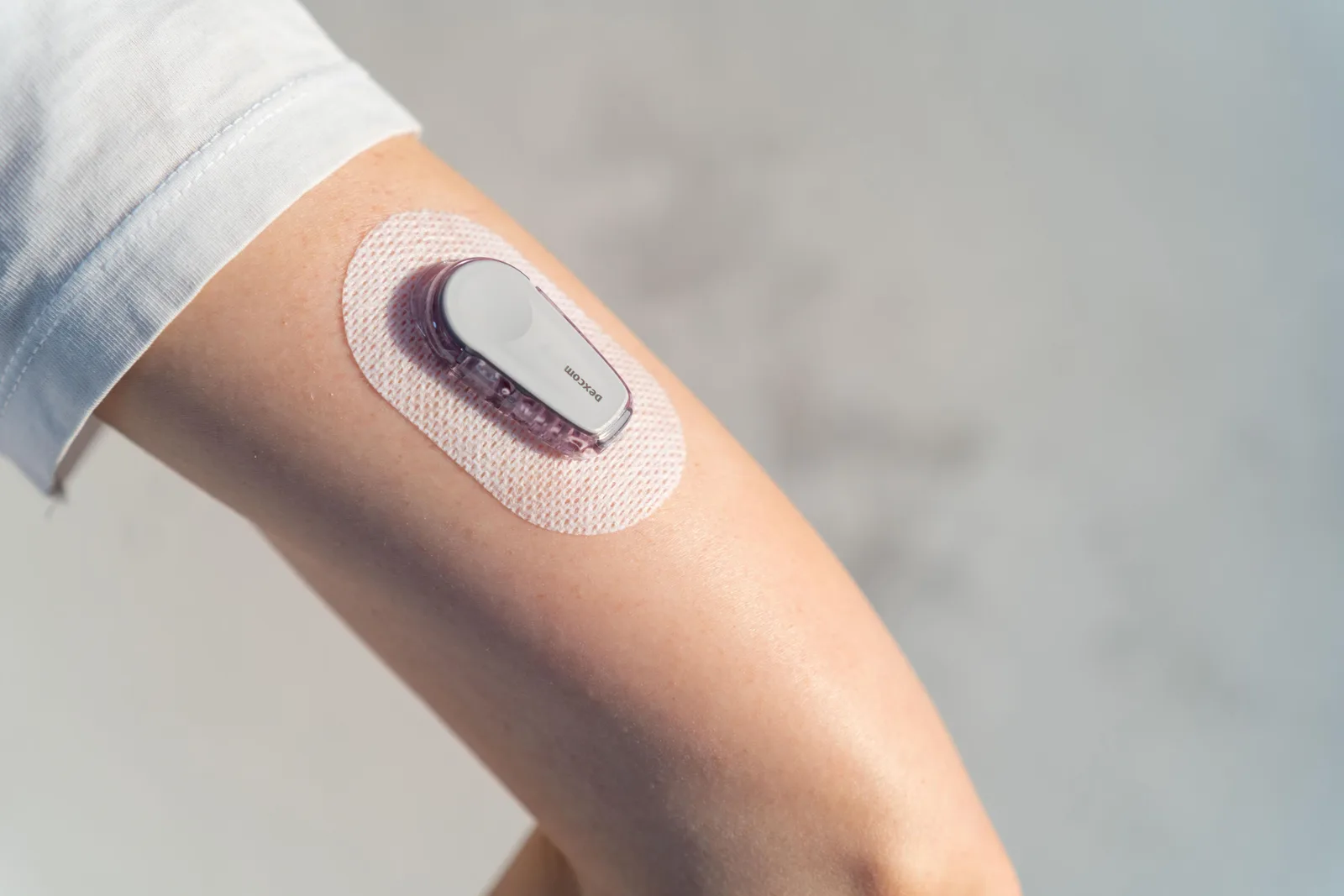 Continuous glucose monitoring technology on a patient's arm